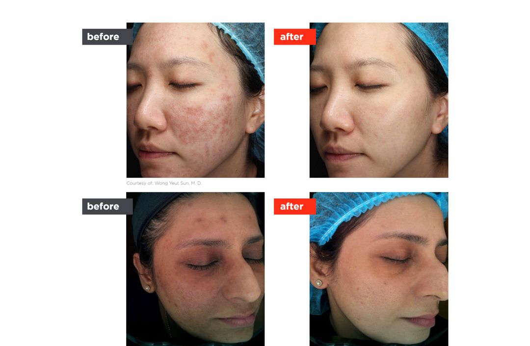 acne laser before and after, The Derm Edit