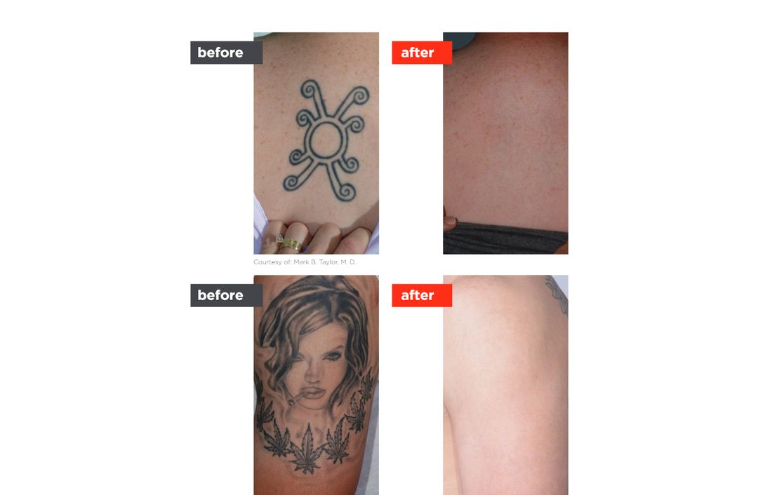 tattoo removal before and after, The Derm Edit