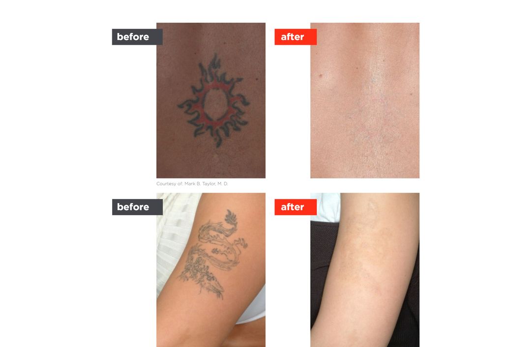 tattoo removal before and after, The Derm Edit