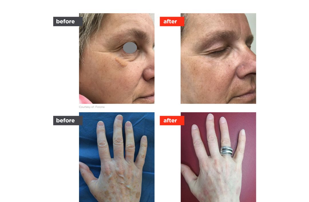 lesion removal before and after, The Derm Edit