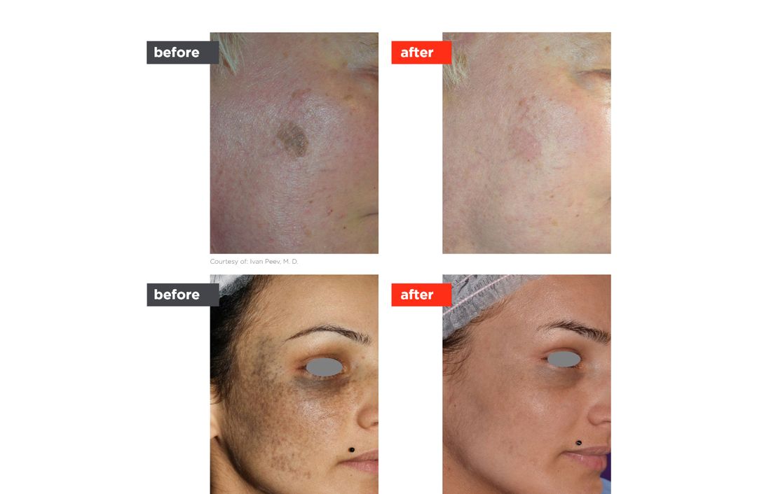 lesion removal before and after, The Derm Edit