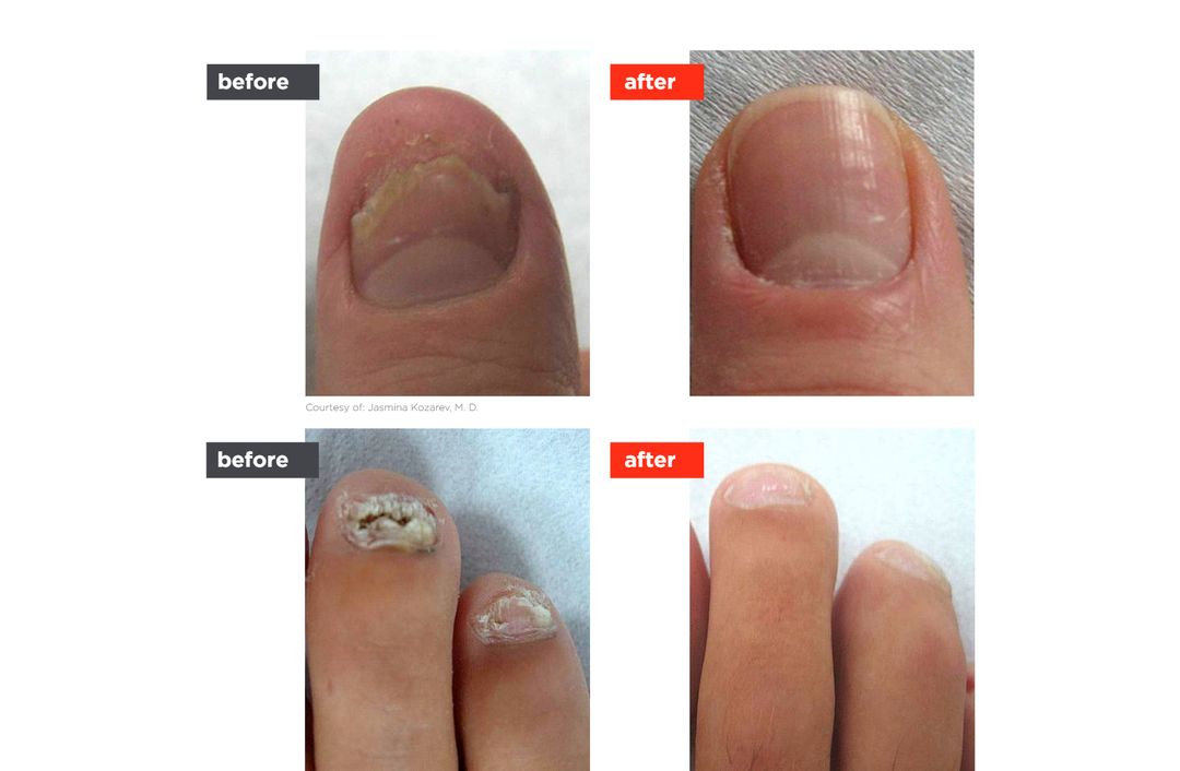 ClearSteps® nail before and after, The Derm Edit