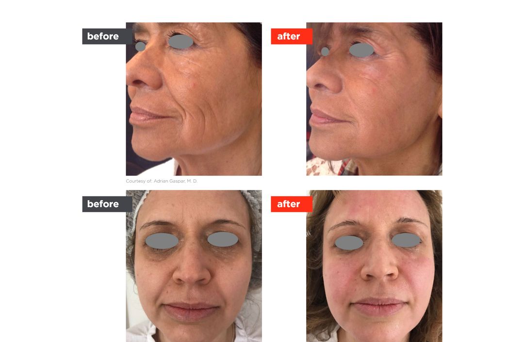 Fotona4D® before and after, The Derm Edit