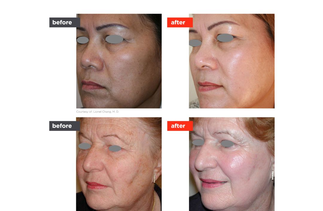 Fotona4D® before and after, The Derm Edit
