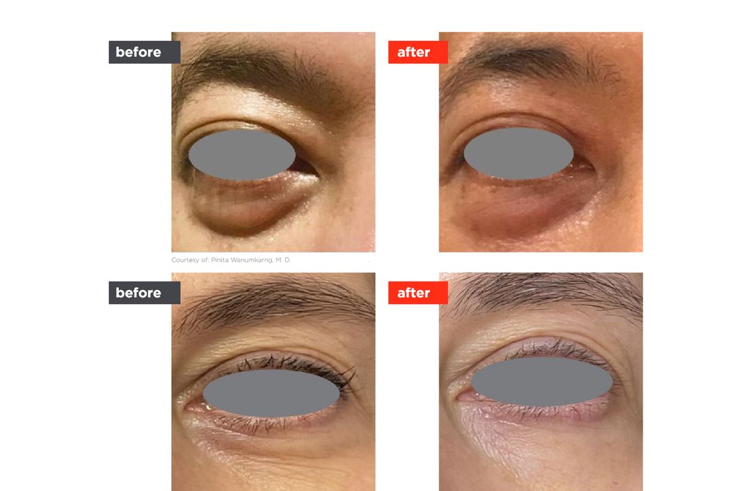SmoothEye® before and after, The Derm Edit