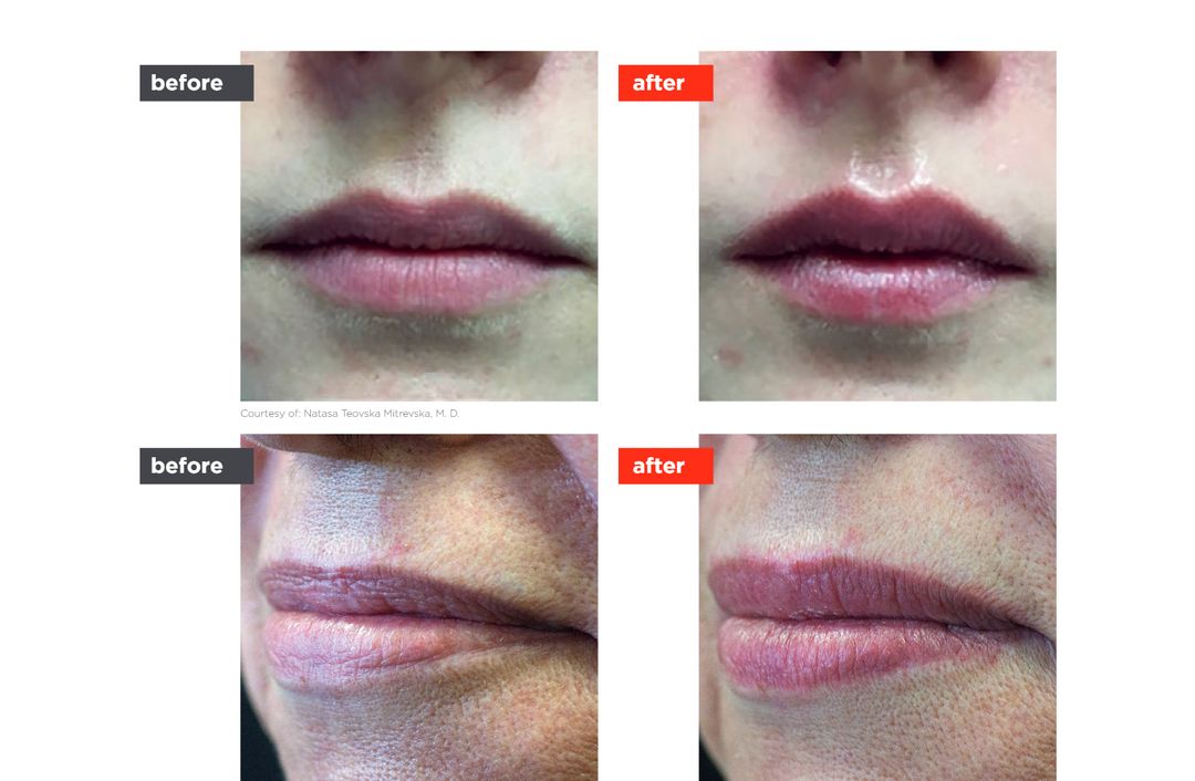 LipLase™ before and after, The Derm Edit