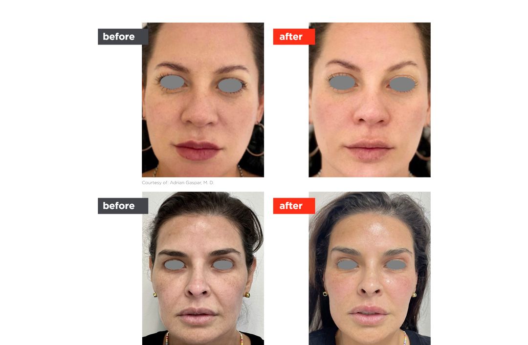 VectorLift® before and after, The Derm Edit