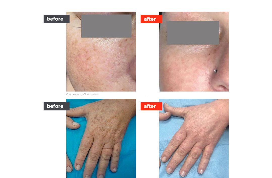 laser toning before and after, The Derm Edit