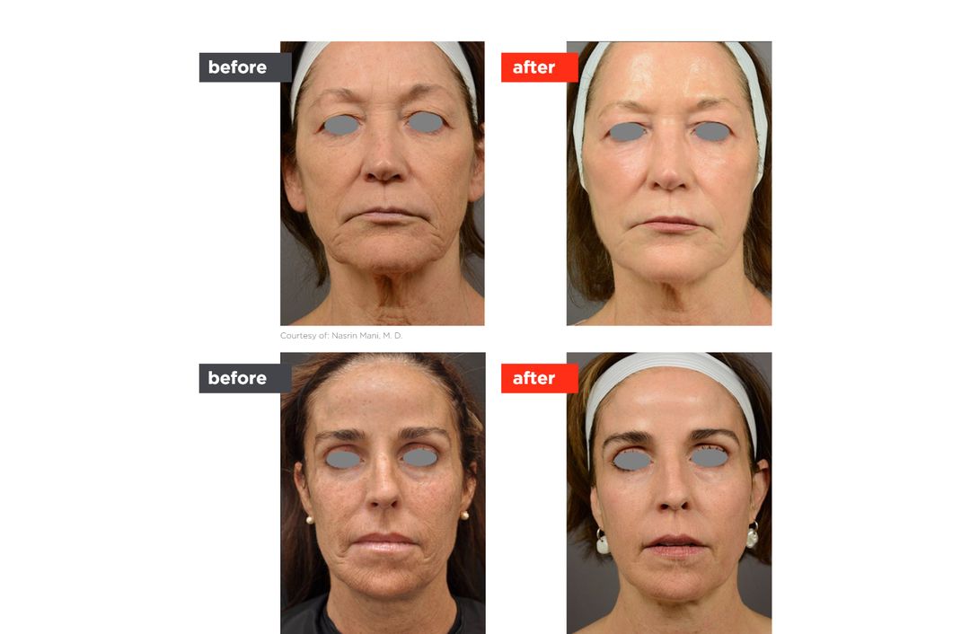 laser resurfacing before and after, The Derm Edit