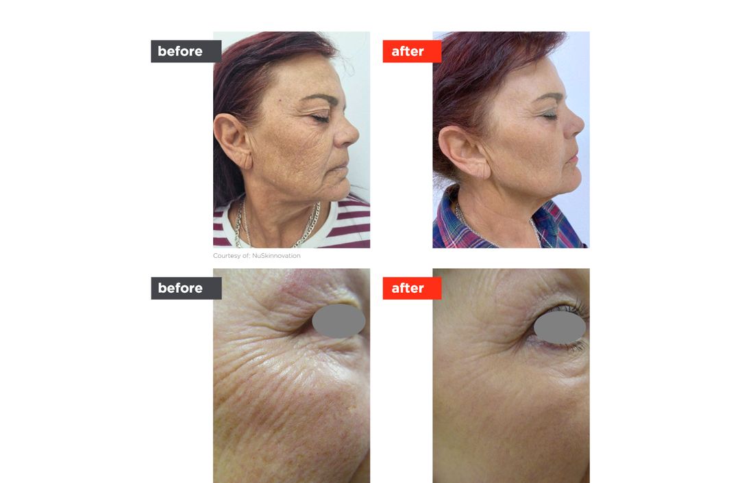 laser resurfacing before and after, The Derm Edit