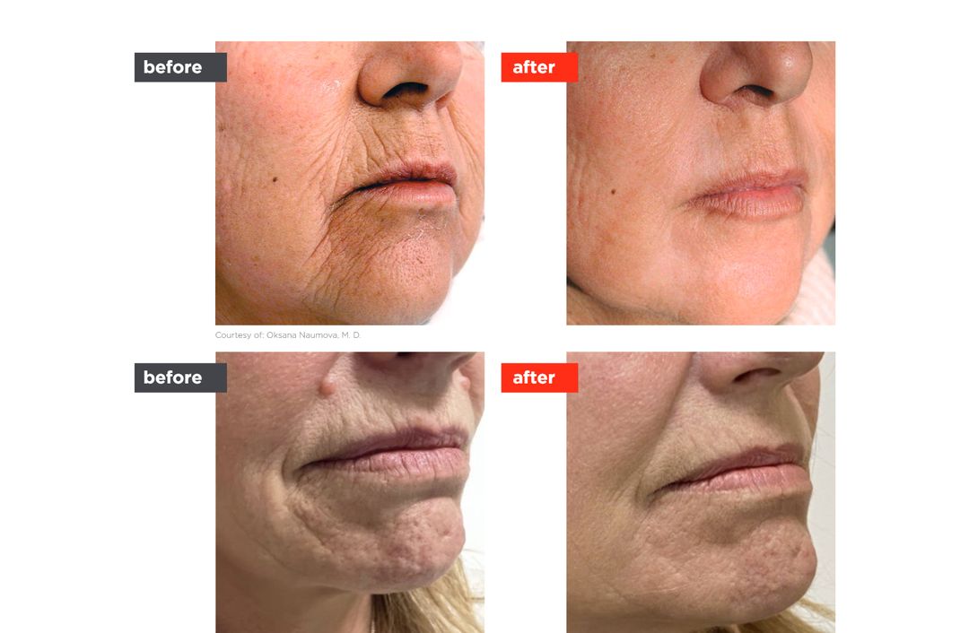 laser resurfacing before and after, The Derm Edit