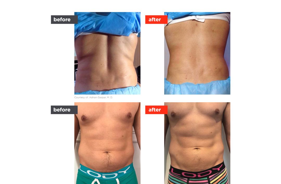 TightSculpting® before and after, The Derm Edit