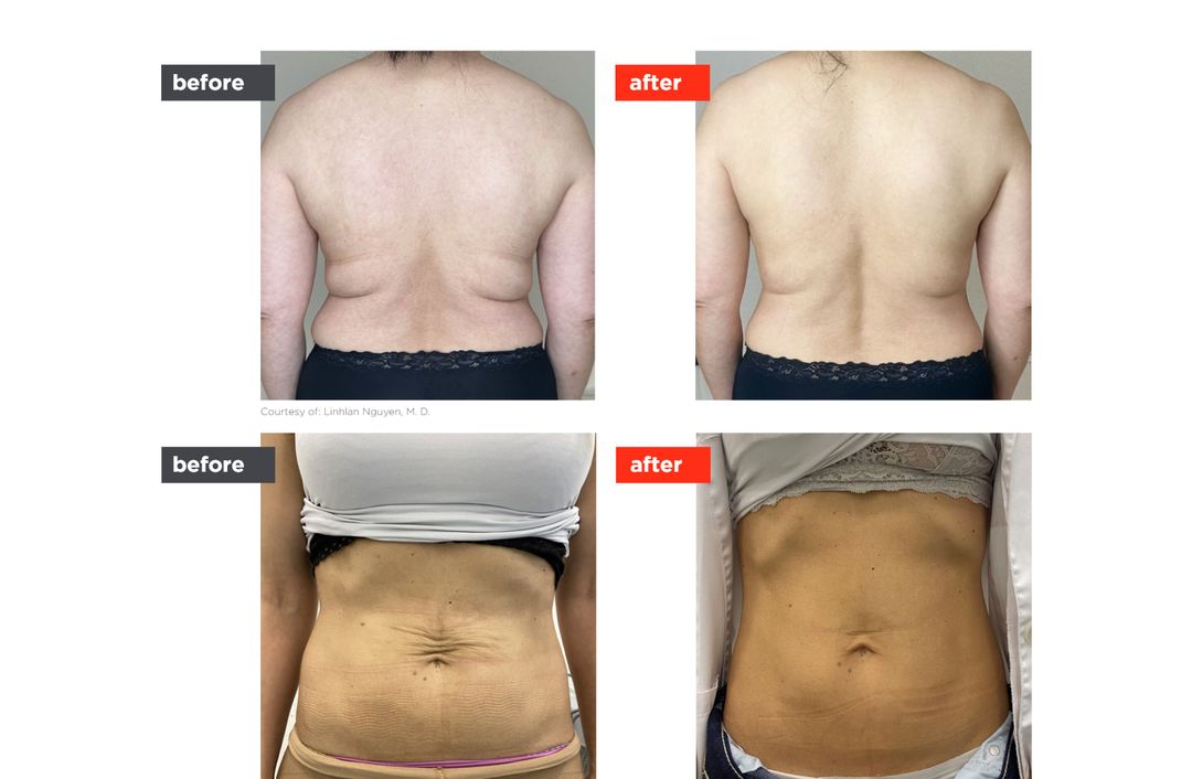 TightSculpting® before and after, The Derm Edit