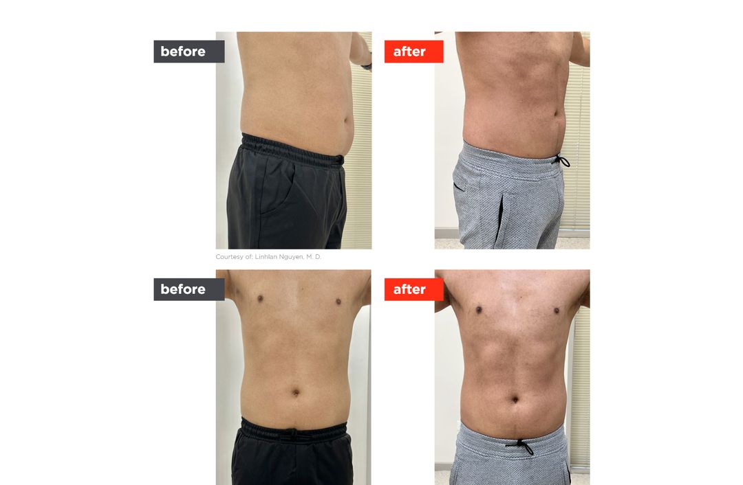TightSculpting® before and after, The Derm Edit