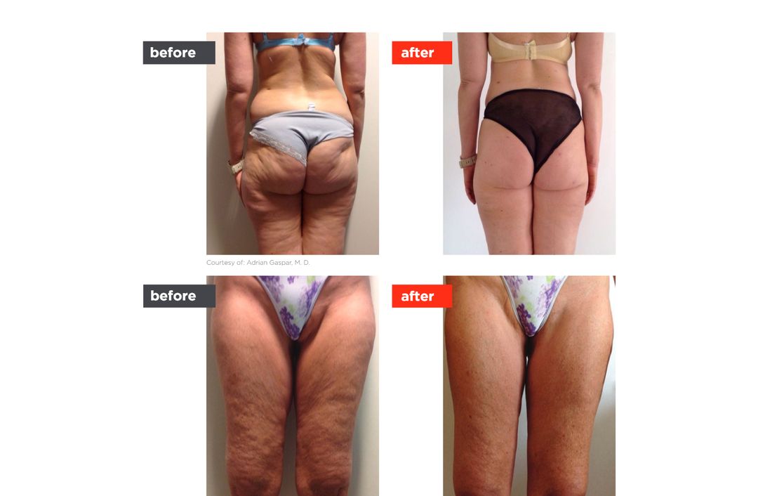 OrangeLase before and after, The Derm Edit