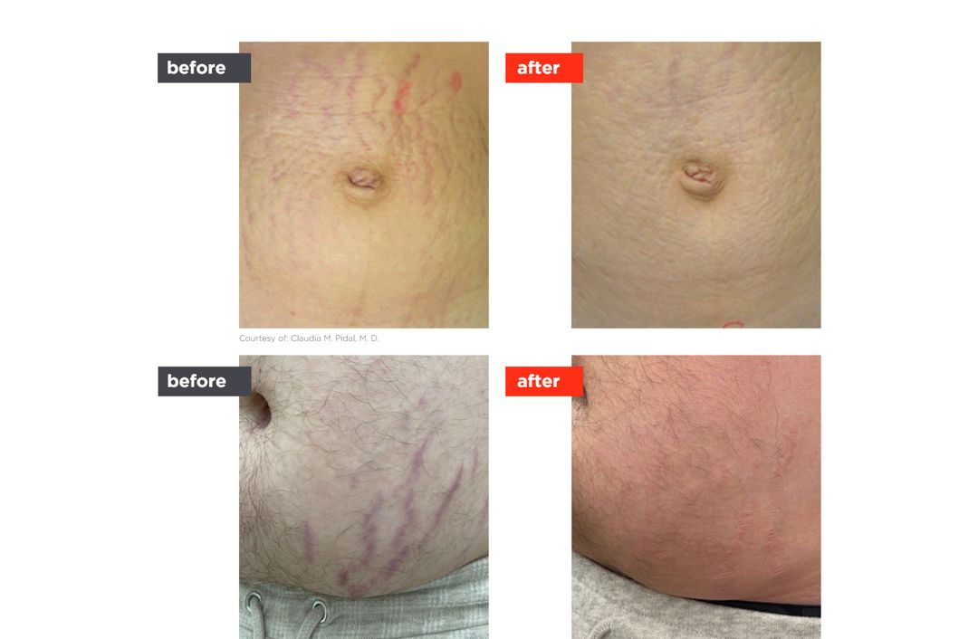 LineLase before and after, The Derm Edit