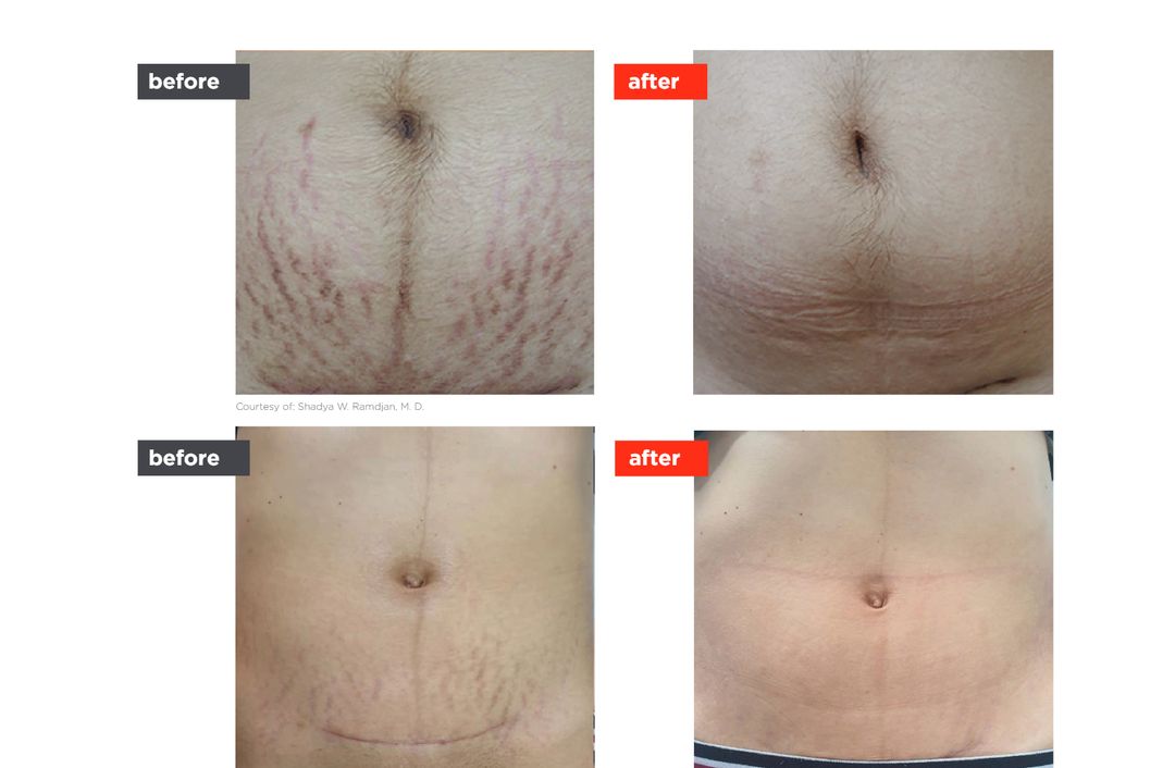LineLase before and after, The Derm Edit