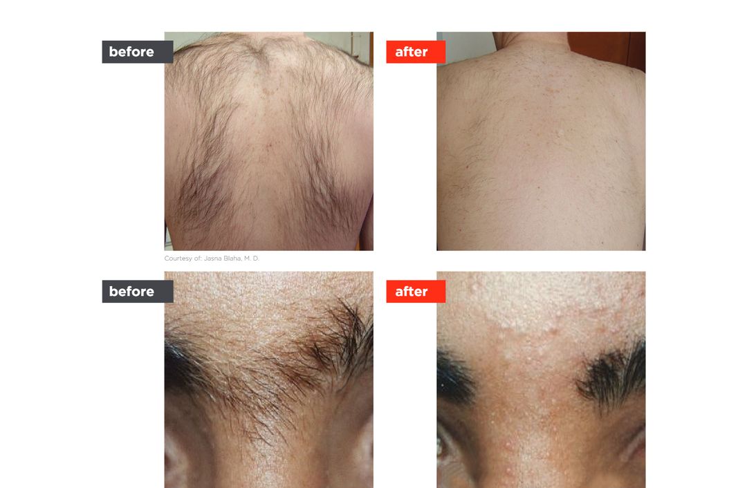 laser hair reduction before and after, The Derm Edit