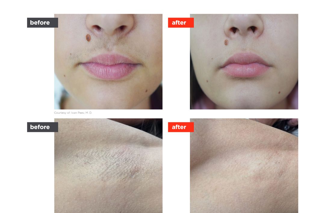 laser hair reduction before and after, The Derm Edit