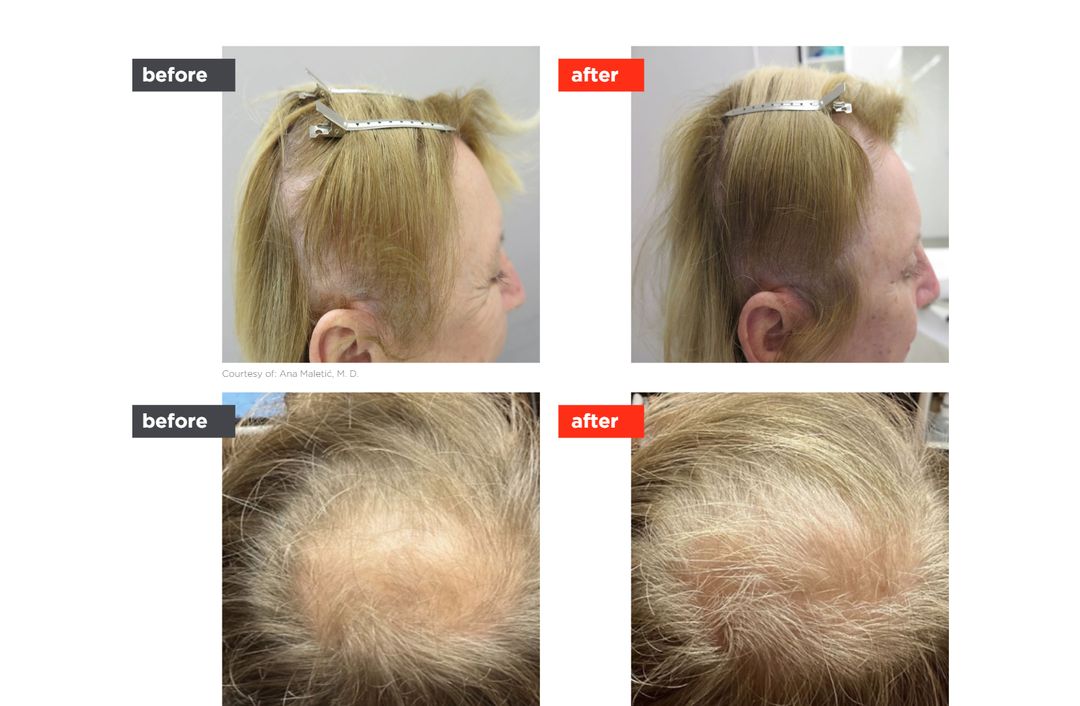 HAIRestart® before and after, The Derm Edit