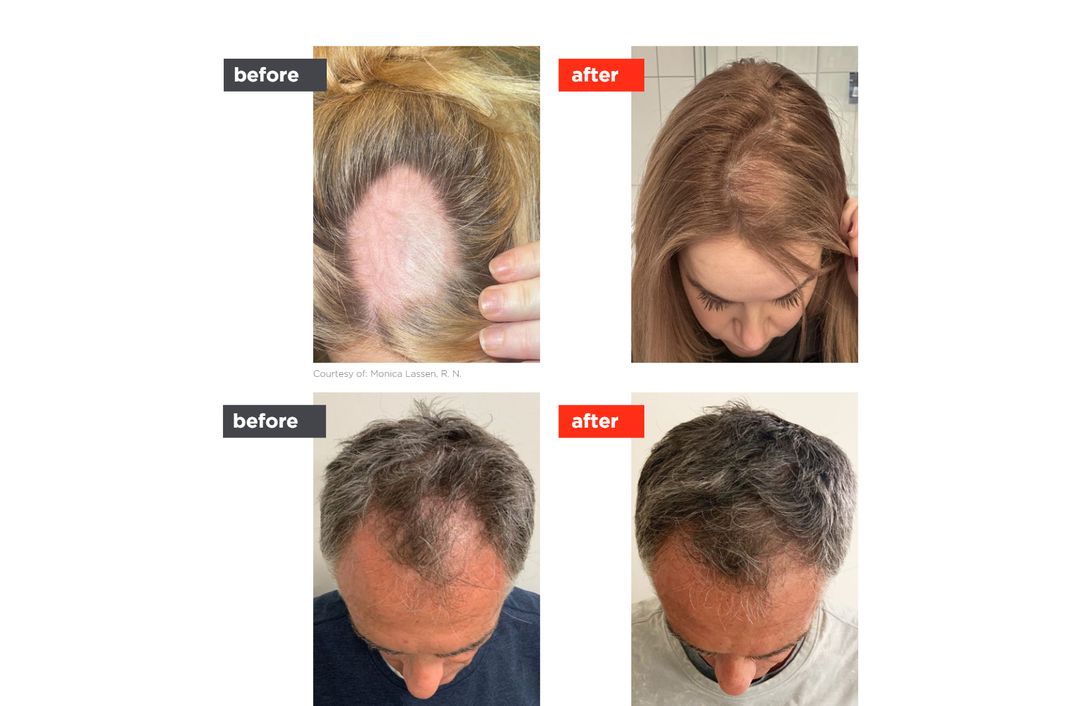 HAIRestart® before and after, The Derm Edit
