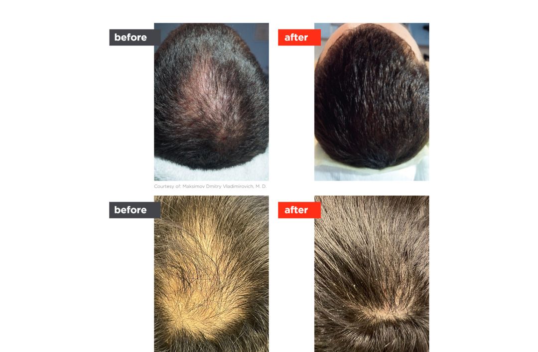 HAIRestart® before and after, The Derm Edit