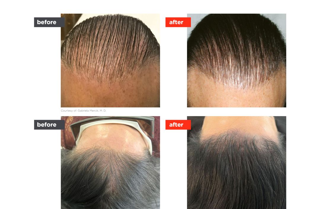 HAIRestart® before and after, The Derm Edit