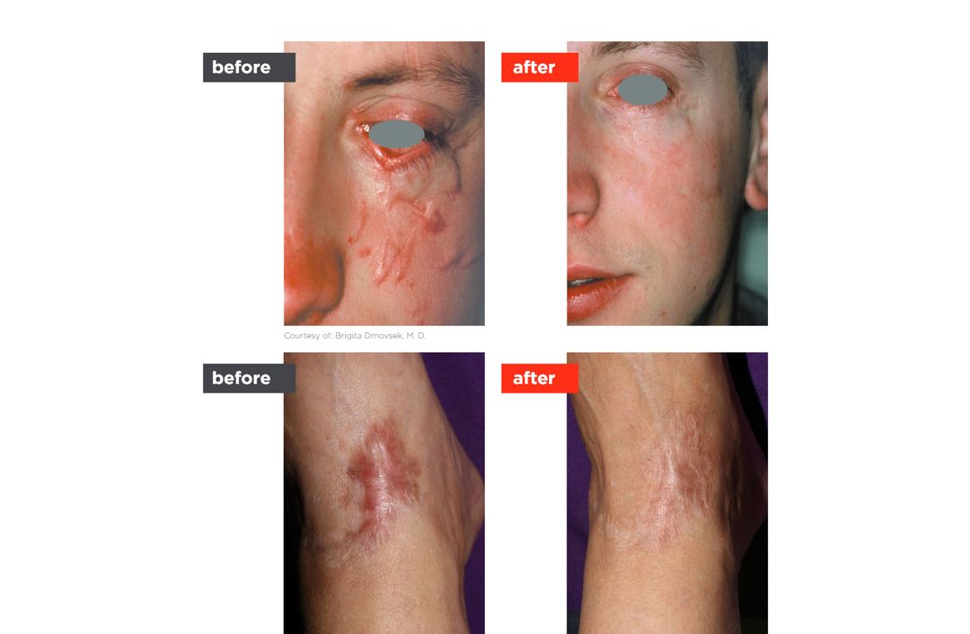 scar laser before and after, The Derm Edit