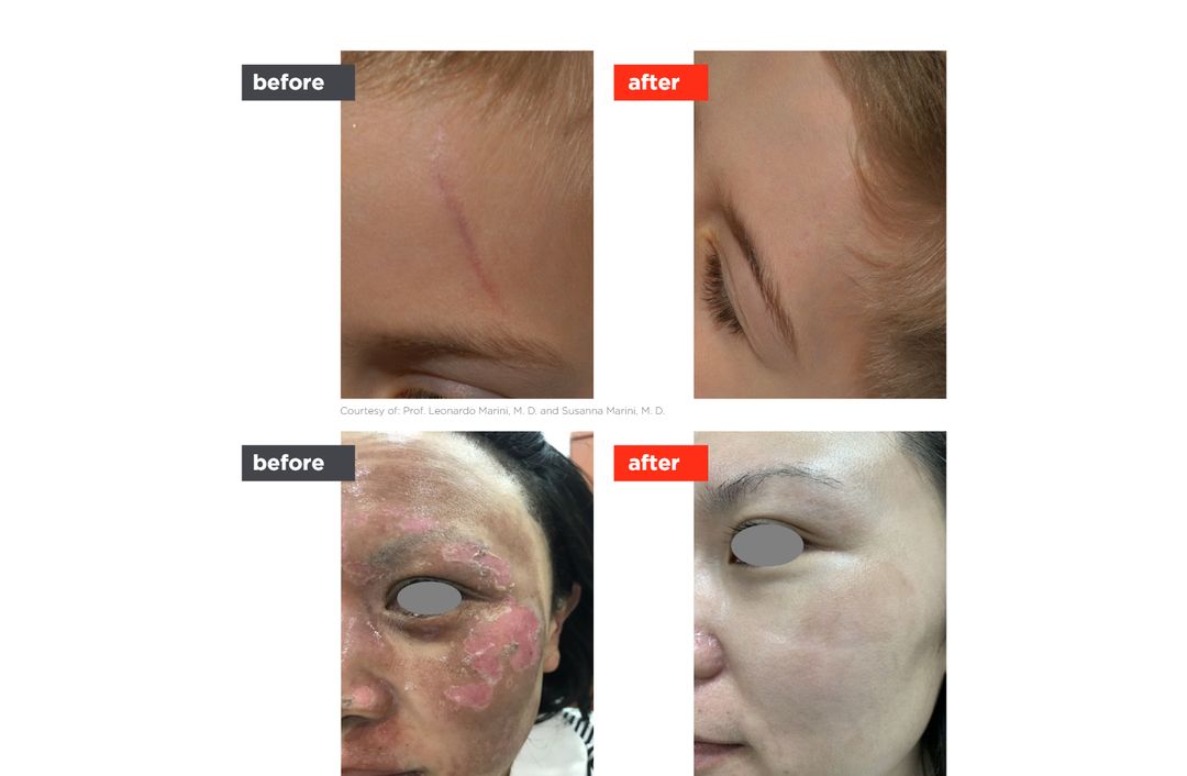 scar laser before and after, The Derm Edit