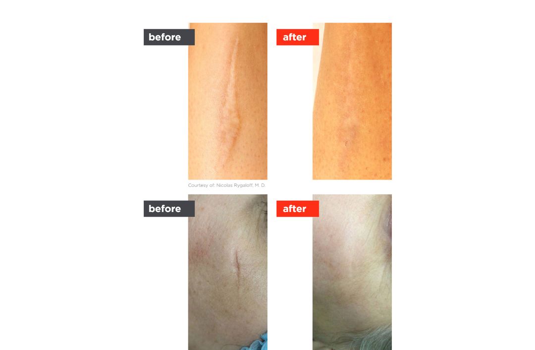 scar laser before and after, The Derm Edit