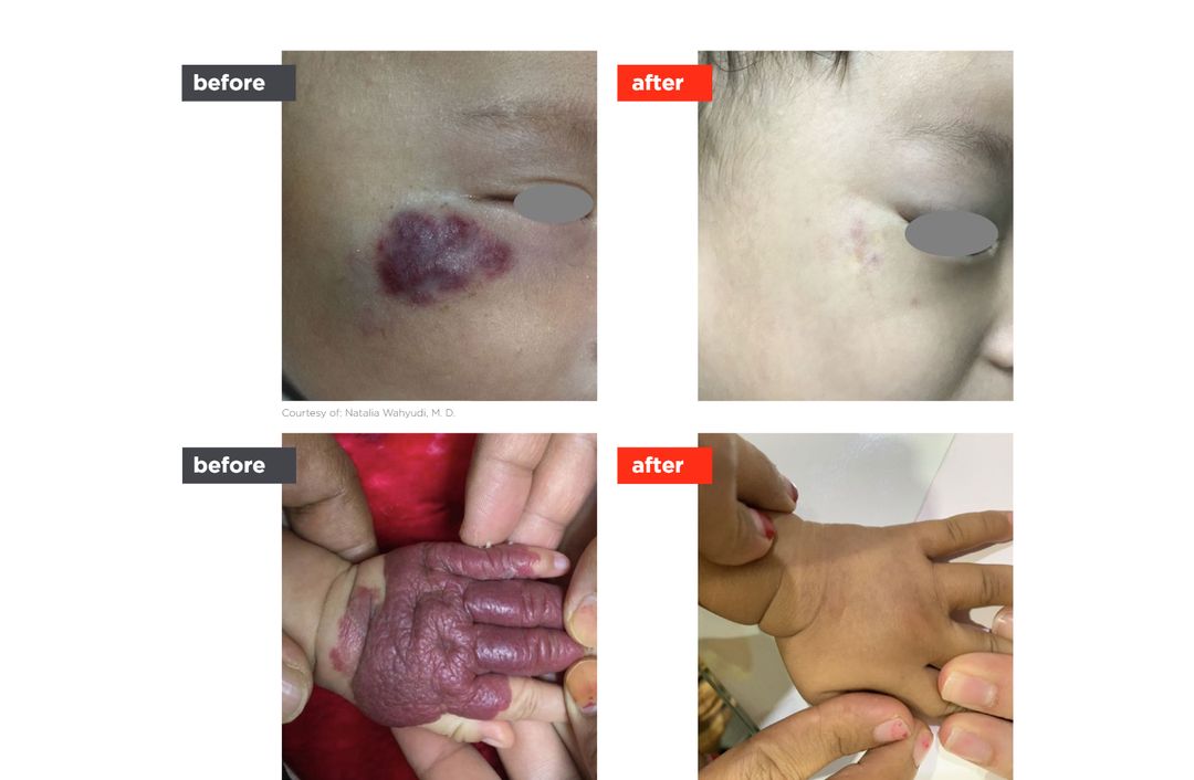 vascular laser before and after, The Derm Edit