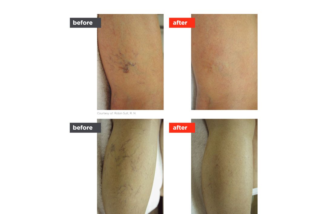 vascular laser before and after, The Derm Edit