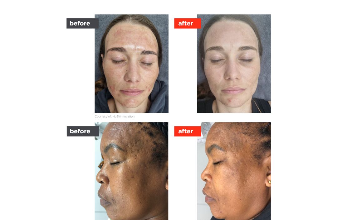 acne laser before and after, The Derm Edit